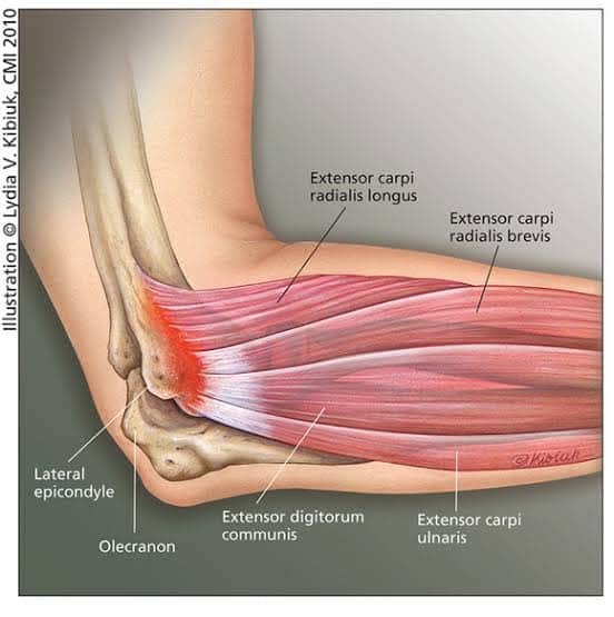 Chek elbow tendinitis Focus